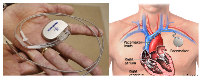 Gambar Permanent Pacemaker device