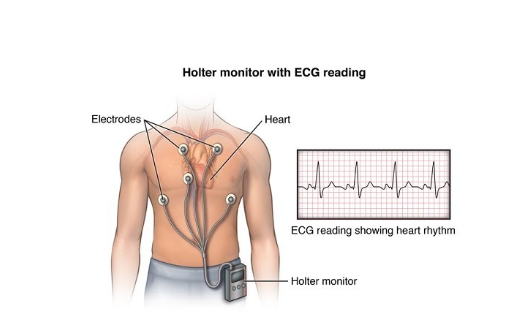 Gambar monitor Holter