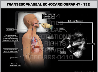 Gambar transesofageal ekokardiografi
